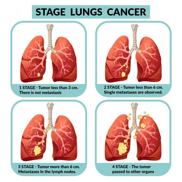 LUNG CANCER